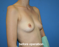 plastic-surgery-breast-augmentation